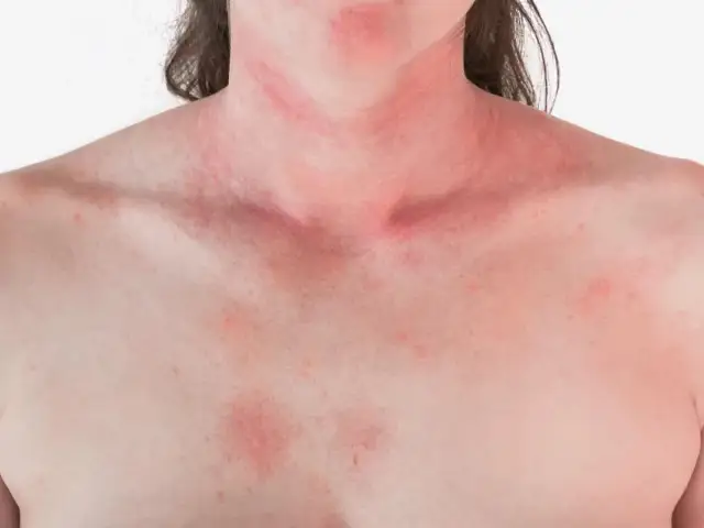 Alergia na truskawki: objawy, reakcje krzyżowe i co robić