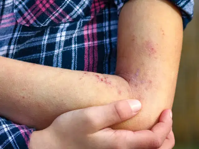 Wysypka jak ugryzienie komara u dziecka? Pokrzywka, alergia, Skeeter