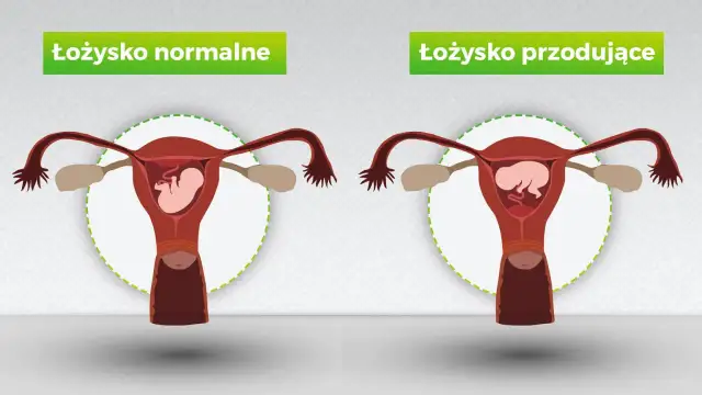 Porównanie: łożysko normalne vs. łożysko przodujące. Ilustracja pokazuje macicę z płodem, gdzie w jednym przypadku łożysko jest prawidłowo umiejscowione, a w drugim przoduje.