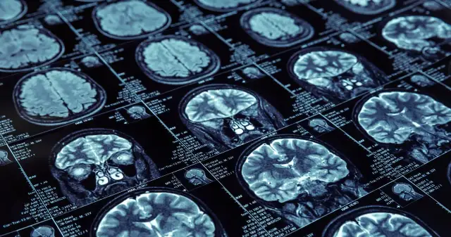 Jak zapobiec Alzheimerowi: skuteczne metody ochrony zdrowia mózgu