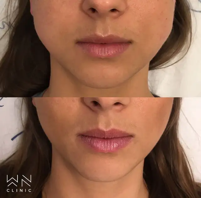 Botoks na bruksizm: Kiedy efekty? Od ulgi po zmianę rysów twarzy