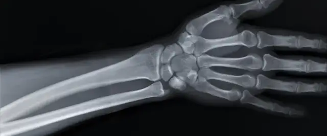 Czy złamana ręka puchnie? Objawy, leczenie i rehabilitacja