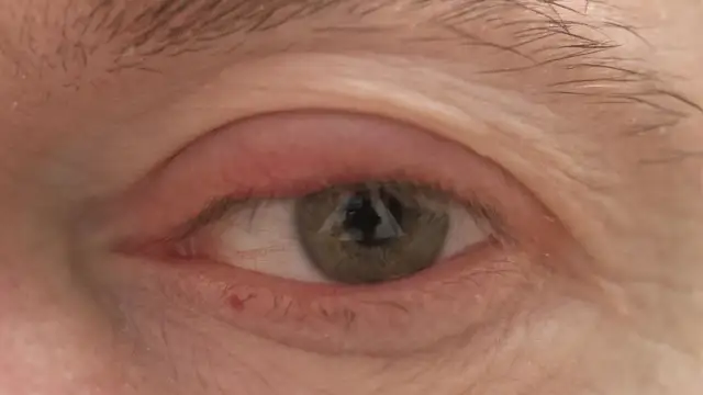 Jakie leki na opuchnięte powieki skutecznie przynoszą ulgę?