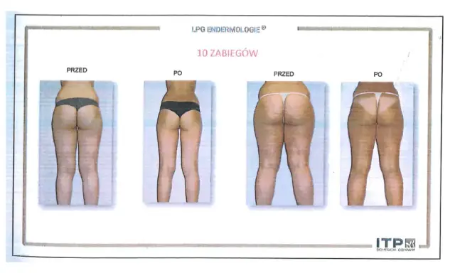 Endermologia: Jak często, ile zabiegów? Ekspert radzi!