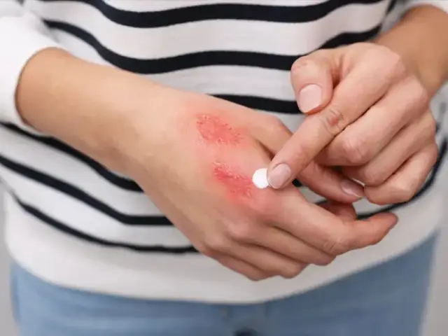 Oparzenie gazem LPG co robić - skuteczne kroki pierwszej pomocy