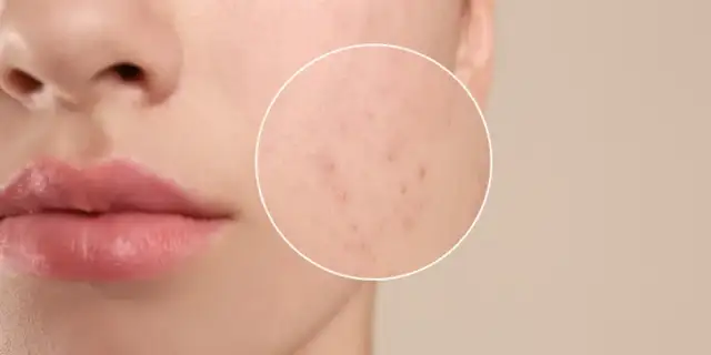 Podskórny pryszcz: Przyspiesz dojrzewanie i uniknij blizn!