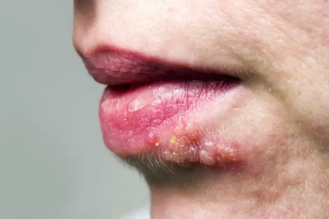 Opryszczka czy pryszcz: jak je odróżnić i skutecznie leczyć