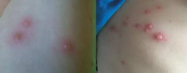 Ospa po kontakcie: Jak zapobiec? 2 metody, czas na reakcję
