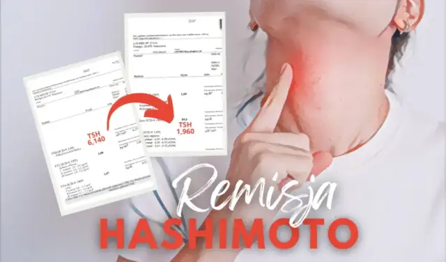 Czy choroba Hashimoto kwalifikuje do renty? Sprawdź kryteria i możliwości