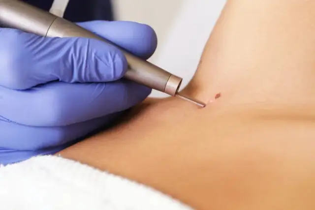 Jaki lekarz usuwa pieprzyki? Sprawdź, jak uniknąć problemów zdrowotnych