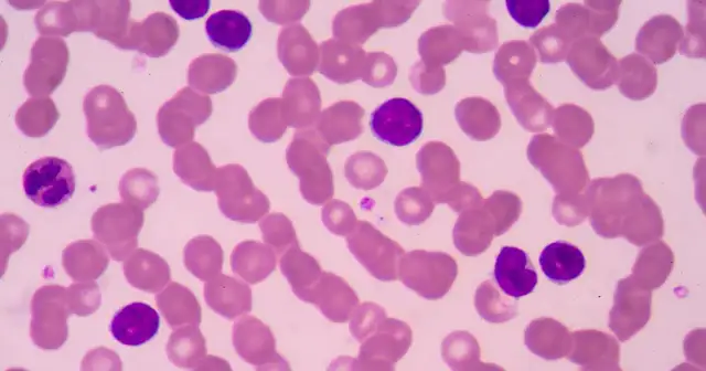 Podwyższone limfocyty w morfologii - Kiedy są powodem do niepokoju?