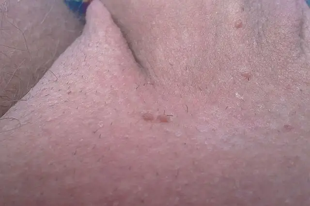 Kłykciny HPV: Do kogo iść? Dermatolog czy Urolog rozstrzygnięte