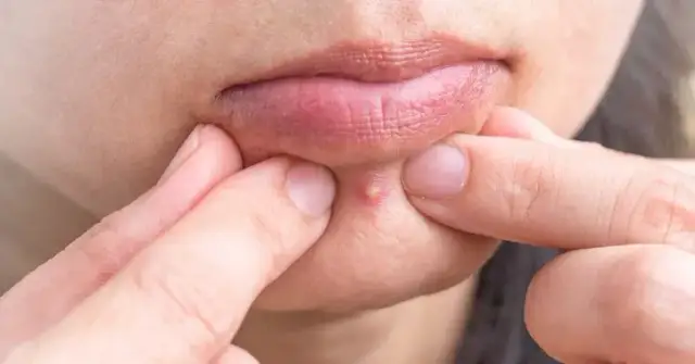 Jak pozbyć się podskórnego pryszcza? Szybkie i bezpieczne domowe sposoby