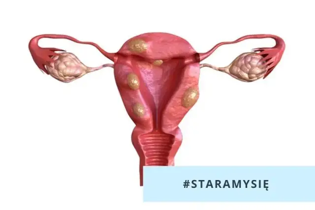 Mięśniaki macicy po menopauzie: Czy zanikają? Kiedy rosną?