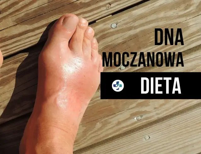 Dna moczanowa: Skuteczna dieta niskopurynowa jedz bez bólu!