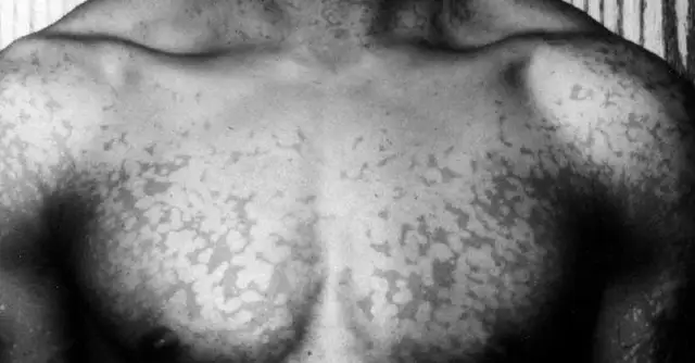 Jakie leki na łupież pstry są najskuteczniejsze w leczeniu?