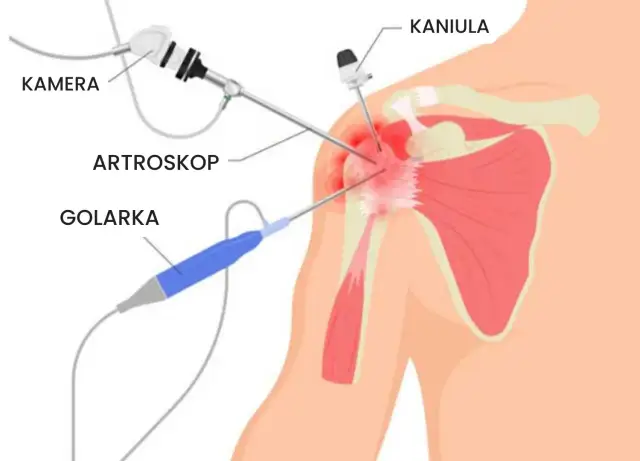Renta po artroskopii barku - Jak skutecznie złożyć wniosek?