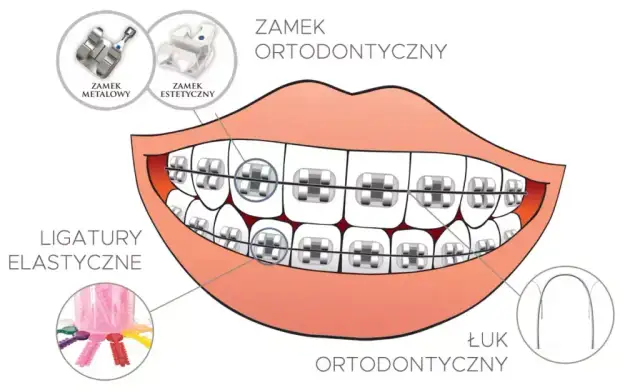 Jak założyć aparat na zęby? Etapy, koszty i pierwsze dni