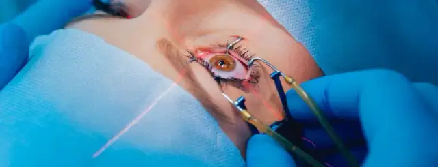 Korekcja astygmatyzmu: Metody, koszty i czy da się wyleczyć?