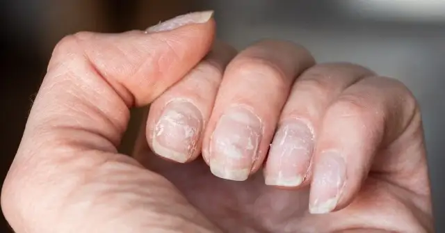 Zniszczone paznokcie po obgryzaniu? Skuteczna odbudowa krok po kroku