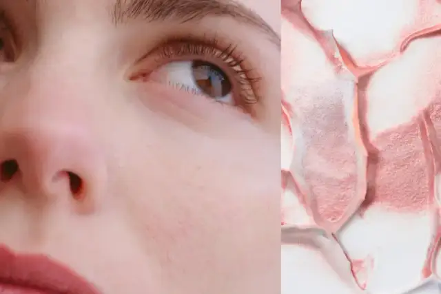 Czego unikać przy cerze naczynkowej? Skuteczne porady i listy