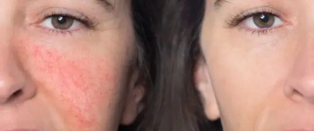 Jaki krem do cery naczynkowej, aby skutecznie wzmocnić naczynia?