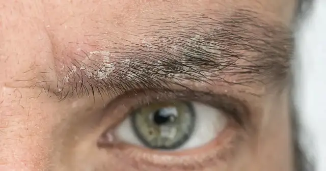 Pryszcz między brwiami: Szybkie sposoby na pozbycie się i zapobieganie