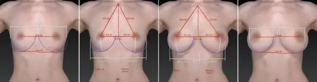 Ile kosztuje powiększanie biustu? Zrozum, co wpływa na ceny zabiegu