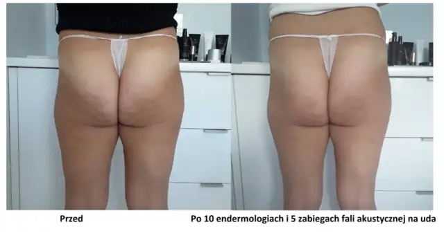 Endermologia: Jak często, by efekty były trwałe?