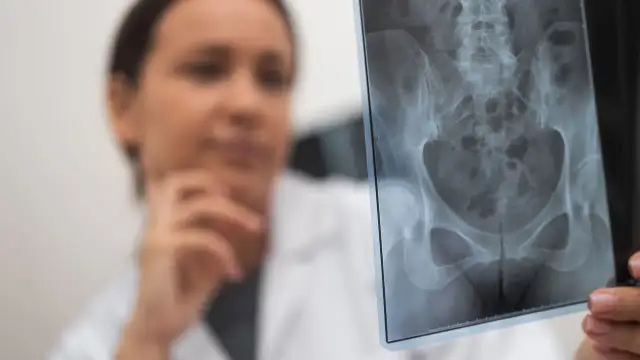 Złamane biodro: 5 kluczowych objawów, które musisz znać