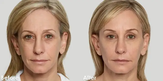 Skuteczne rozwiązania na zmarszczki po 60 – popraw wygląd skóry