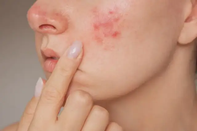 Skuteczne sposoby na wybielenie czerwonych plam po pryszczach