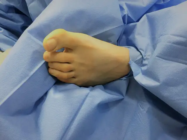 Krzywy palec u nóg dziecka: przyczyny, objawy i skuteczne leczenie