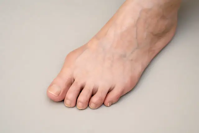 Myślę, że to dobry moment, aby zastanowić się nad tytułem meta. Haluksy: Skutecznie pozbądź się bólu i deformacji!