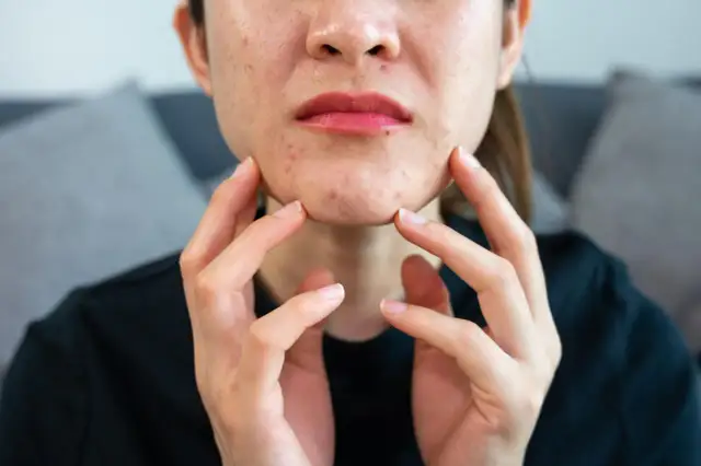 Rana po pryszczu? Zagój ją szybko domowymi metodami i uniknij blizn