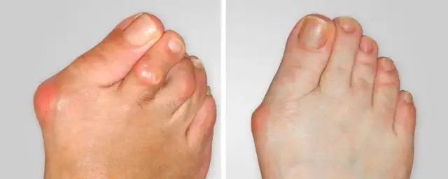 Haluksy: Co naprawdę je powoduje? Fakty i mity o deformacji stóp