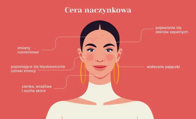 Cera naczynkowa: 7 objawów, które musisz znać - Poradnik