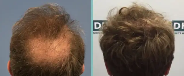 Biotin für Haare: Vorher-Nachher-Ergebnisse & realistische Erwartungen