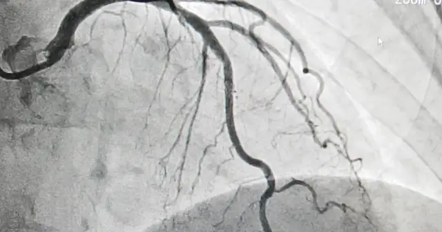 Odszkodowanie za koronarografię - Kiedy i jak o nie walczyć?