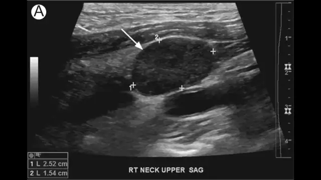 Lymph morfologia - Jak czytać wynik i kiedy warto się martwić?