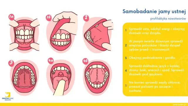Jak wygląda rak jamy ustnej? Kluczowe objawy i jak je rozpoznać
