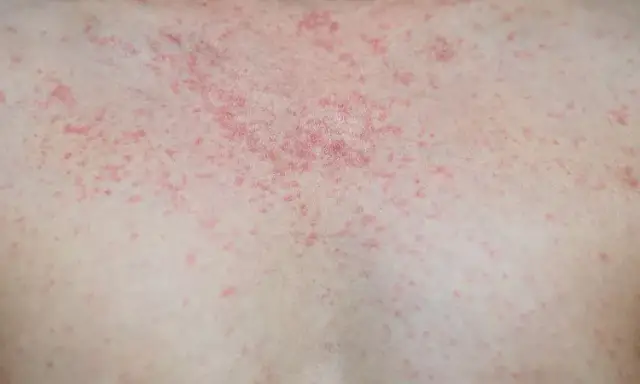 Rumień nagły u dorosłych objawy - jak je rozpoznać i leczyć