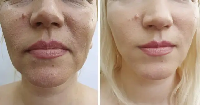 Mezoterapia igłowa dzień po: porównanie skóry przed i po zabiegu. Wygładzenie zmarszczek i poprawa tekstury cery.