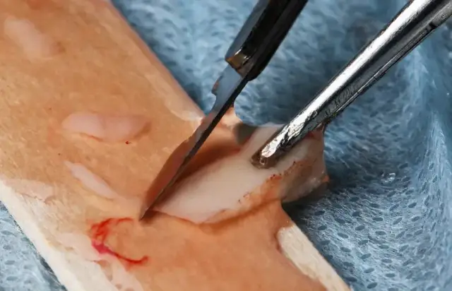 Przeszczep dziąsła: Czy warto? Cena, metody, opinie