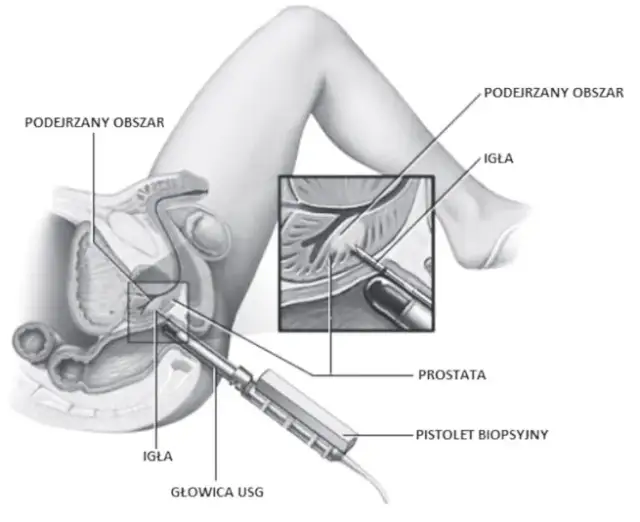 Biopsja prostaty: Co musisz wiedzieć? Przebieg, przygotowanie, wyniki