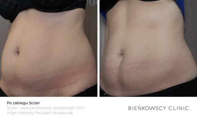 Wiotka skóra po odchudzaniu? Ujędrnij ją dietą i ćwiczeniami!