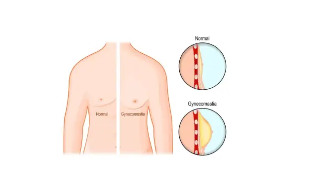 Ginekomastia jaki lekarz - jak uniknąć błędnych diagnoz i leczenia