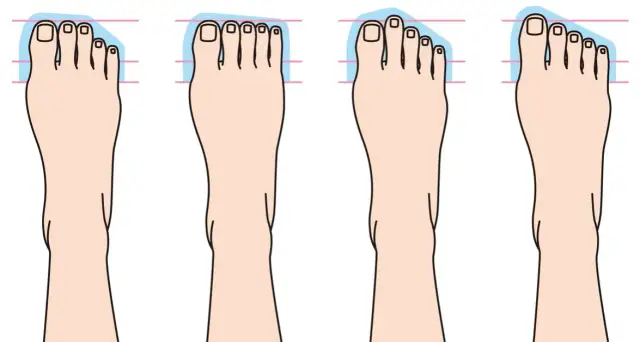 Co zrobić z haluksami? Skuteczne metody na ulgę i leczenie