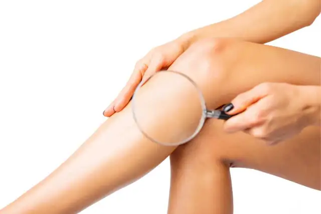 Czy opalanie po depilacji laserowej jest bezpieczne? Sprawdź!