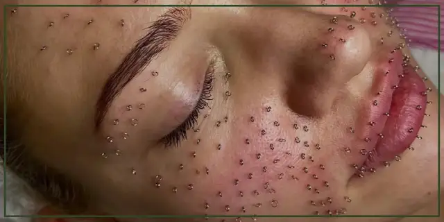 Akupunktura na zmarszczki: Naturalny lifting twarzy? Poznaj efekty